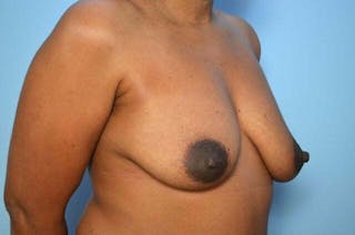 Breast Implant Removal Before & After Gallery - Patient 327747 - Image 4