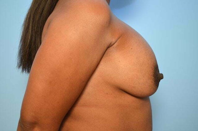 Breast Implant Removal Before & After Gallery - Patient 327747 - Image 5