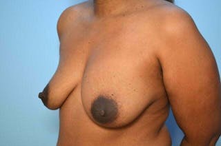 Breast Implant Removal Before & After Gallery - Patient 327747 - Image 8