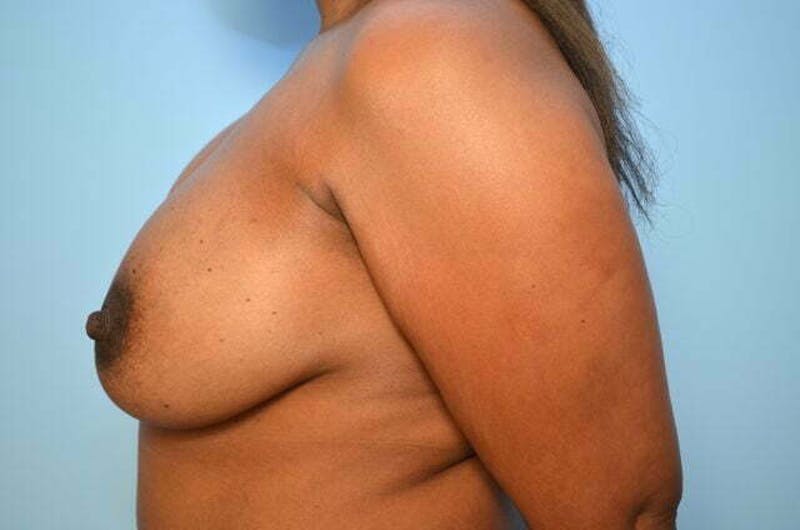 Breast Implant Removal Before & After Gallery - Patient 327747 - Image 9