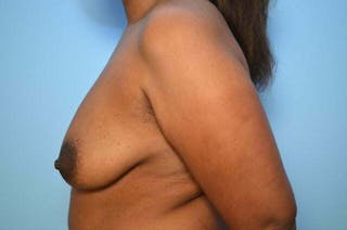 Breast Implant Removal Before & After Gallery - Patient 327747 - Image 10