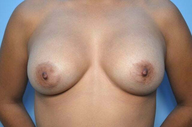 Breast Implant Removal Before & After Gallery - Patient 109838 - Image 1