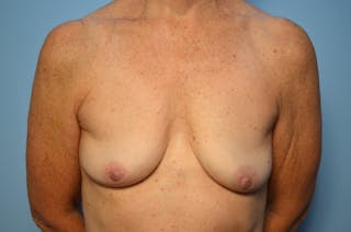 Breast Implant Removal Before & After Gallery - Patient 213290 - Image 2