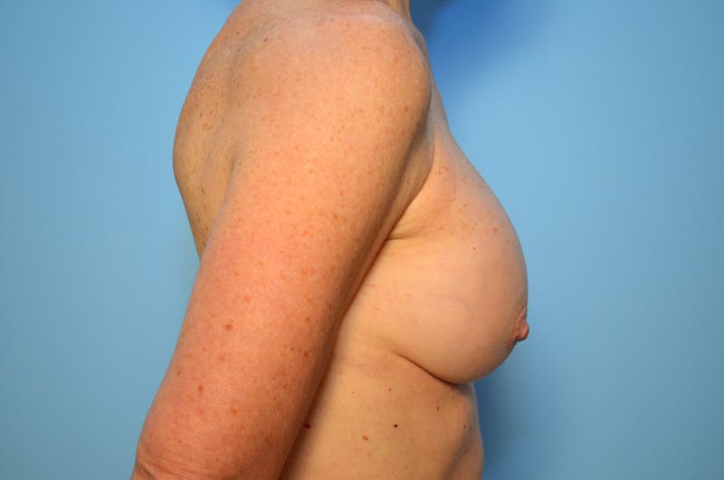 Breast Implant Removal Before & After Gallery - Patient 213290 - Image 5
