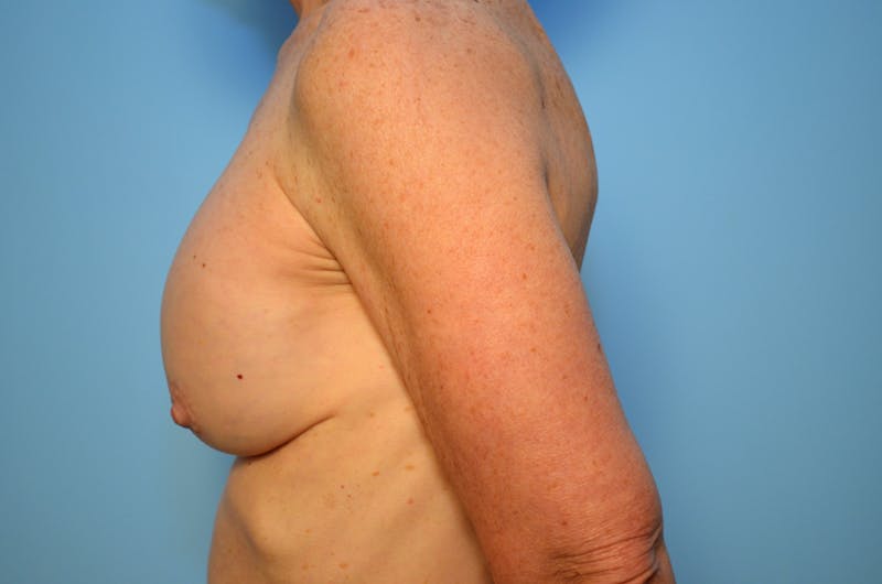 Breast Implant Removal Before & After Gallery - Patient 213290 - Image 9