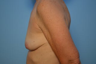 Breast Implant Removal Before & After Gallery - Patient 213290 - Image 10