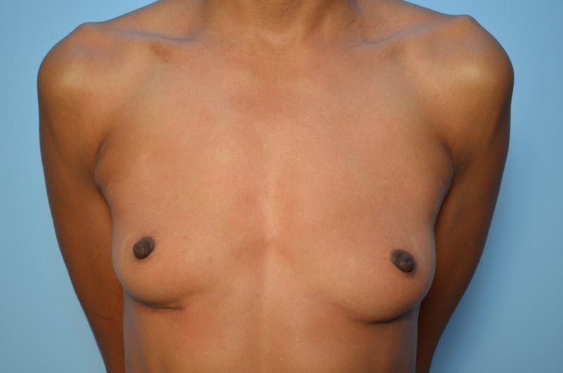 Breast Implant Removal Before & After Gallery - Patient 153562 - Image 2