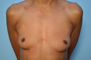 Breast Implant Removal Before & After Gallery - Patient 153562 - Image 2