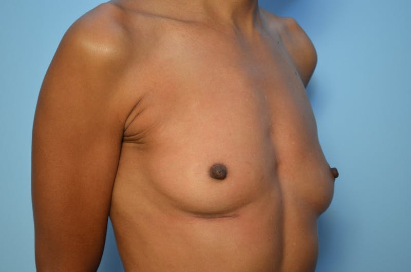 Breast Implant Removal Before & After Gallery - Patient 153562 - Image 4
