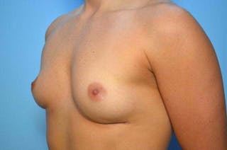 Breast Implant Removal Before & After Gallery - Patient 318173 - Image 8