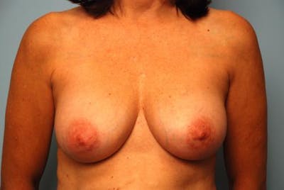 Breast Implant Revision Before & After Gallery - Patient 202617 - Image 2