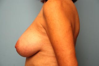 Breast Implant Exchange Before & After Gallery - Patient 207684 - Image 10