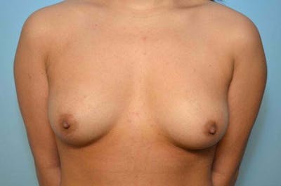Breast Implant Revision Before & After Gallery - Patient 268182 - Image 1