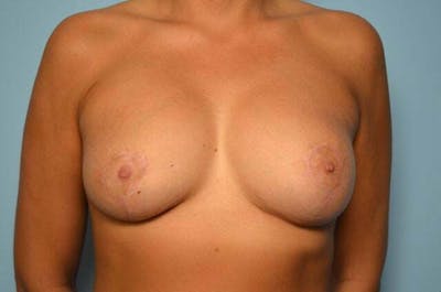 Breast Implant Revision Before & After Gallery - Patient 694913 - Image 2