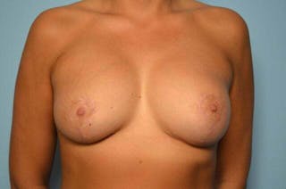 Breast Implant Exchange Before & After Gallery - Patient 556529 - Image 2
