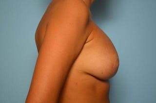 Breast Implant Exchange Before & After Gallery - Patient 556529 - Image 6