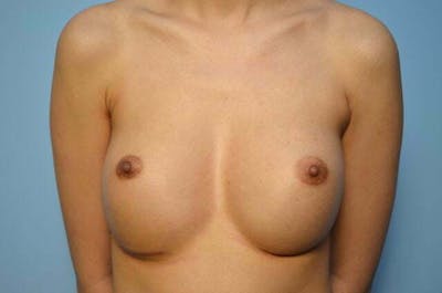 Breast Implant Revision Before & After Gallery - Patient 154929 - Image 1