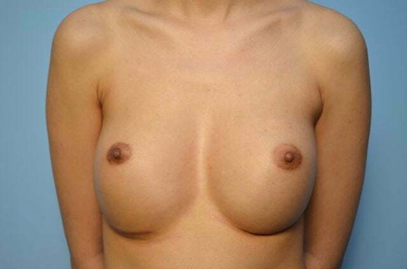 Breast Implant Exchange Before & After Gallery - Patient 209585 - Image 1