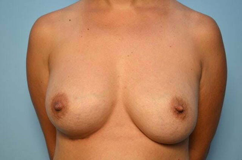 Breast Implant Exchange Before & After Gallery - Patient 327432 - Image 2