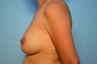 Breast Implant Exchange Before & After Gallery - Patient 327432 - Image 10