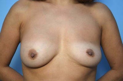 Breast Implant Revision Before & After Gallery - Patient 155802 - Image 1