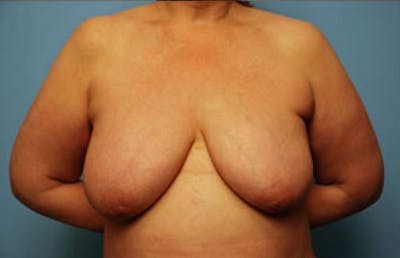 Breast Lift Before & After Gallery - Patient 350716 - Image 1