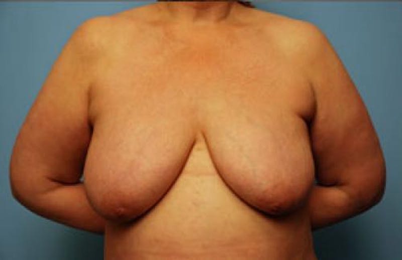 Breast Lift Before & After Gallery - Patient 401068 - Image 1