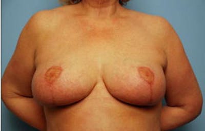 Breast Lift Before & After Gallery - Patient 350716 - Image 2