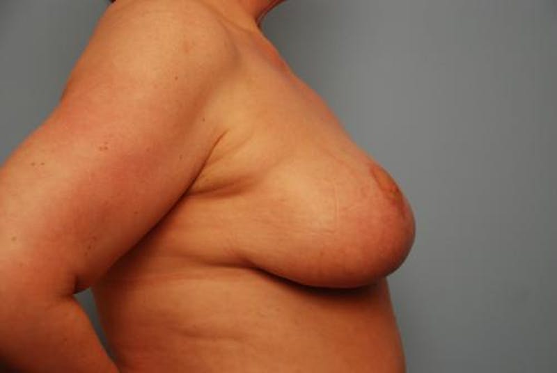 Breast Lift Before & After Gallery - Patient 401068 - Image 6
