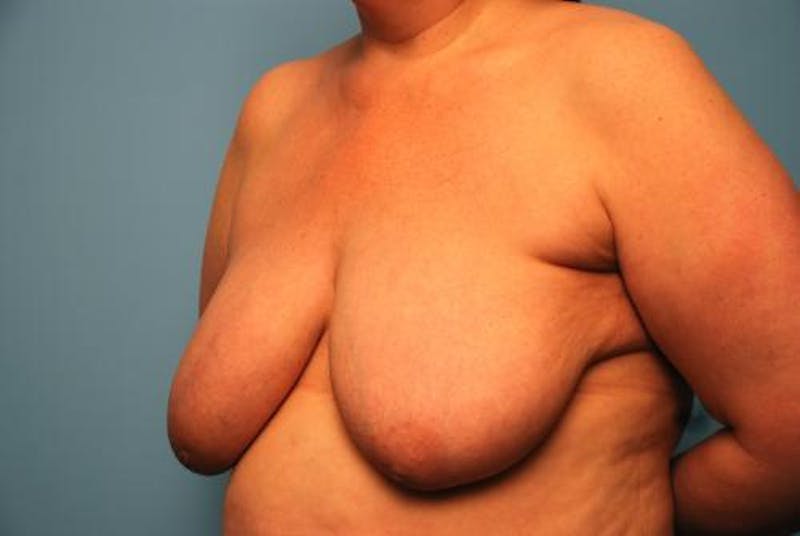 Breast Lift Before & After Gallery - Patient 401068 - Image 7