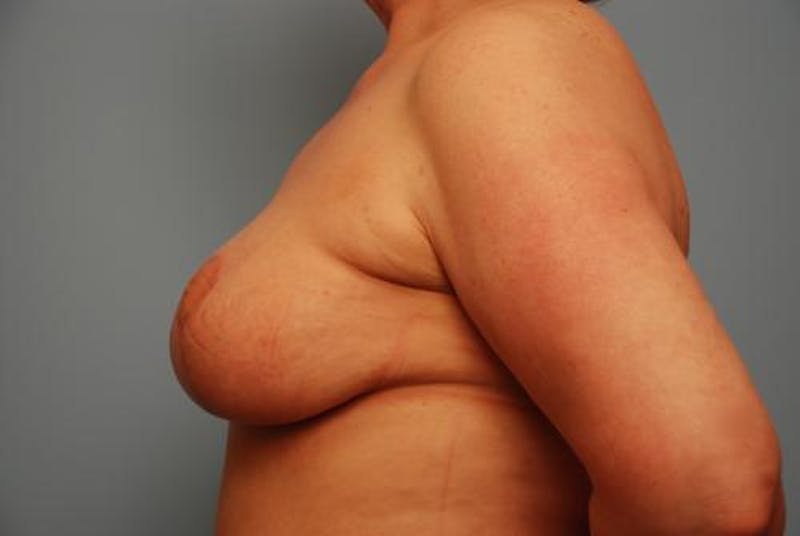 Breast Lift Before & After Gallery - Patient 401068 - Image 10