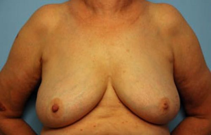 Breast Lift Before & After Gallery - Patient 237469 - Image 1