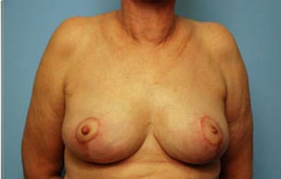 Breast Lift Before & After Gallery - Patient 212449 - Image 2