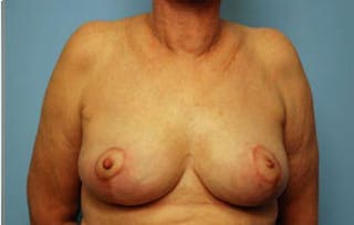 Breast Lift Before & After Gallery - Patient 237469 - Image 2