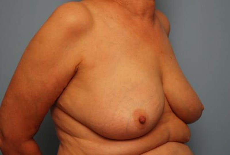 Breast Lift Before & After Gallery - Patient 237469 - Image 3