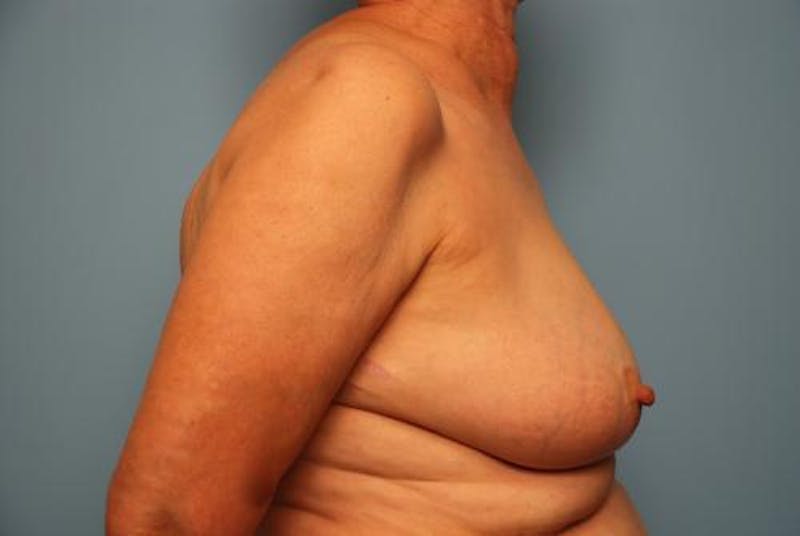 Breast Lift Before & After Gallery - Patient 237469 - Image 5