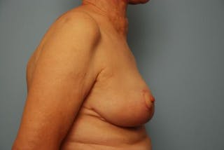 Breast Lift Before & After Gallery - Patient 237469 - Image 6