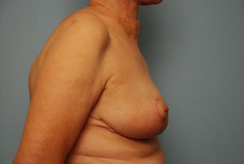 Breast Lift Before & After Gallery - Patient 237469 - Image 6
