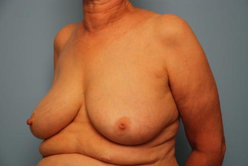 Breast Lift Before & After Gallery - Patient 237469 - Image 7