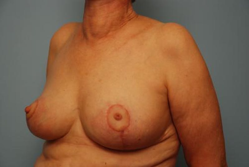 Breast Lift Before & After Gallery - Patient 237469 - Image 8