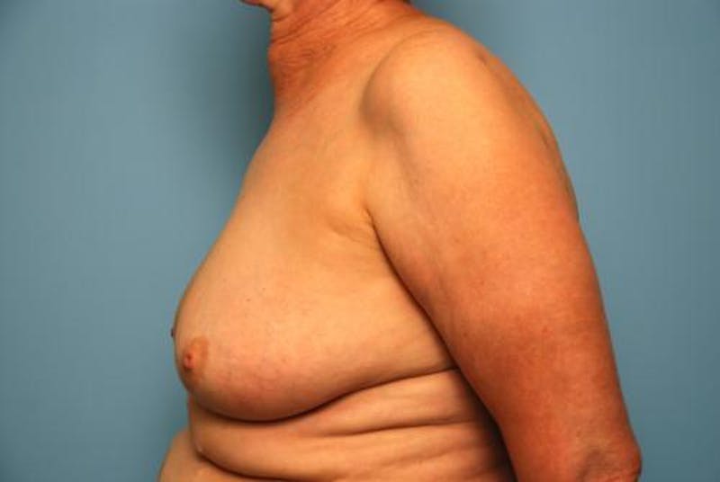 Breast Lift Before & After Gallery - Patient 237469 - Image 9