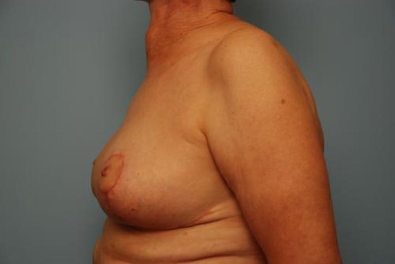 Breast Lift Before & After Gallery - Patient 237469 - Image 10