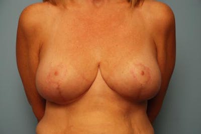 Breast Lift Before & After Gallery - Patient 427006 - Image 2