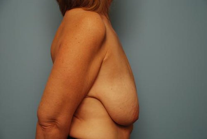 Breast Lift Before & After Gallery - Patient 287510 - Image 5