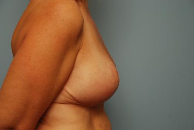 Breast Lift Before & After Gallery - Patient 287510 - Image 6
