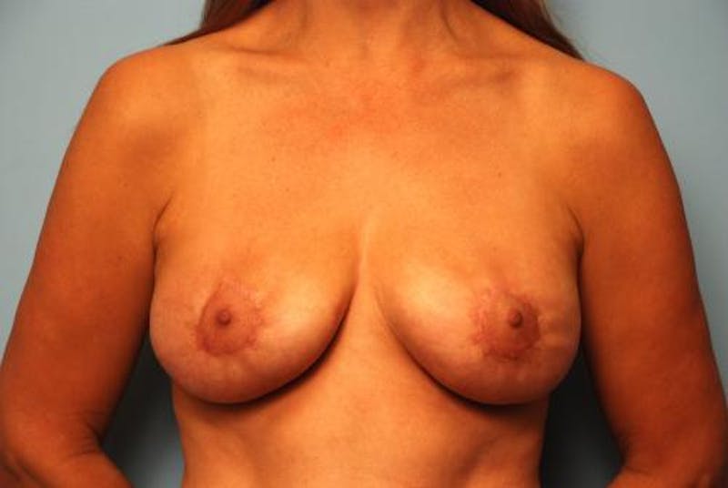 Breast Lift Before & After Gallery - Patient 387210 - Image 2