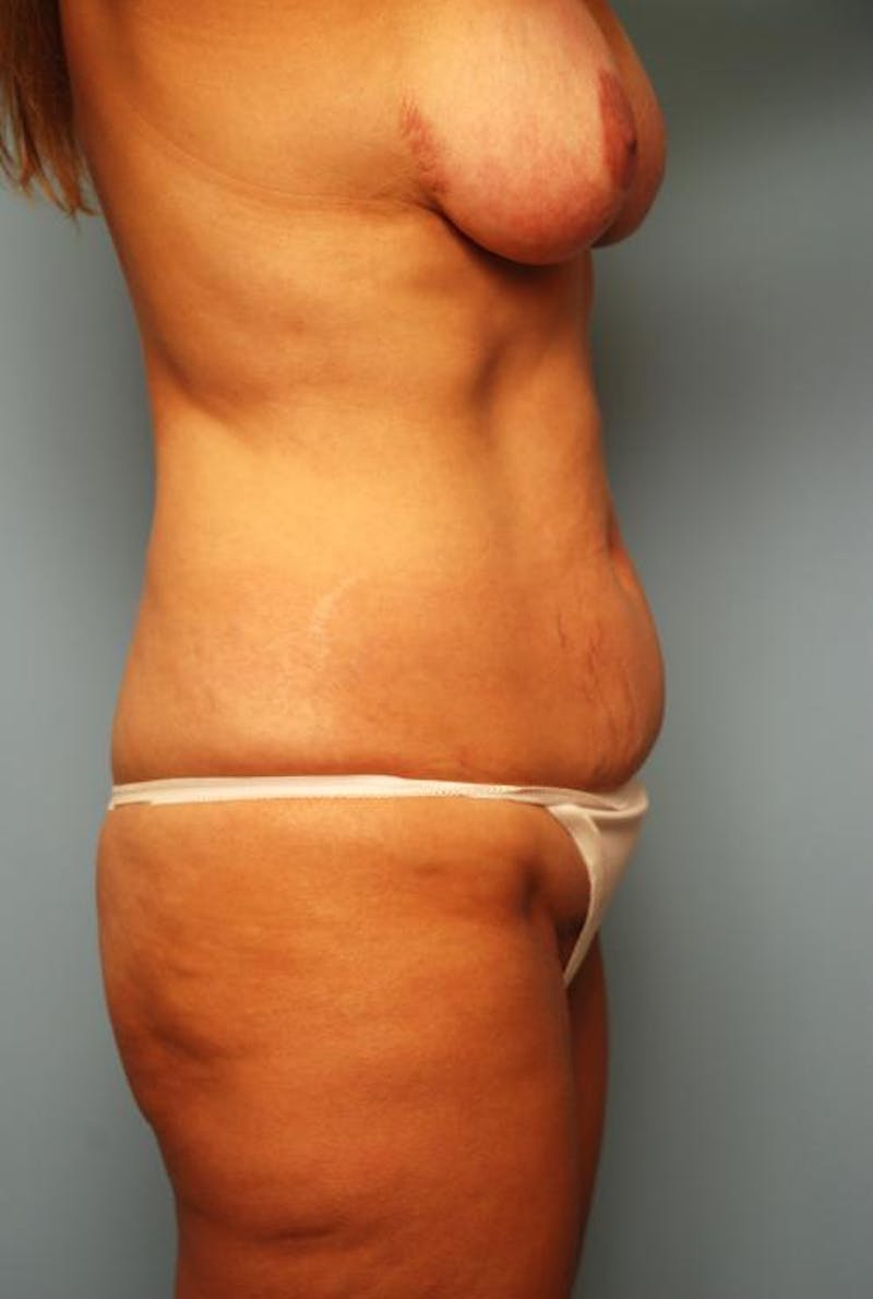 Tummy Tuck Before & After Gallery - Patient 192437 - Image 5