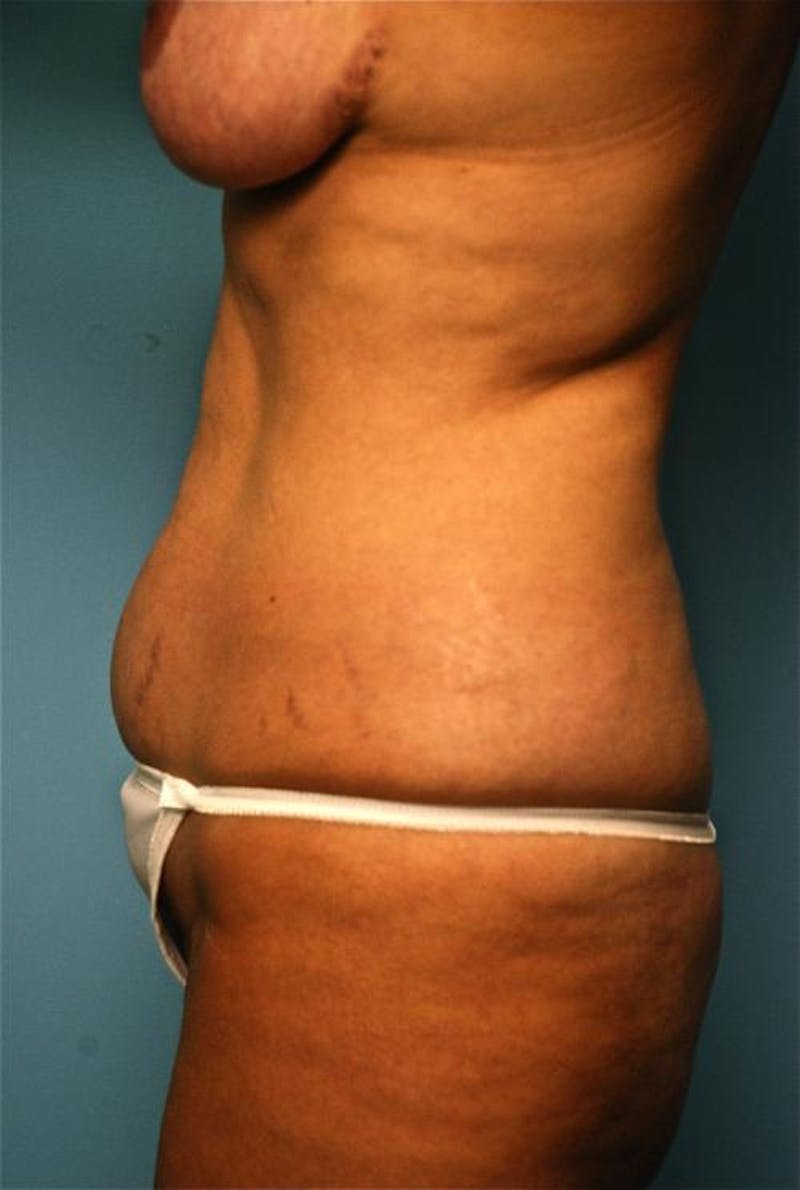 Tummy Tuck Before & After Gallery - Patient 192437 - Image 9