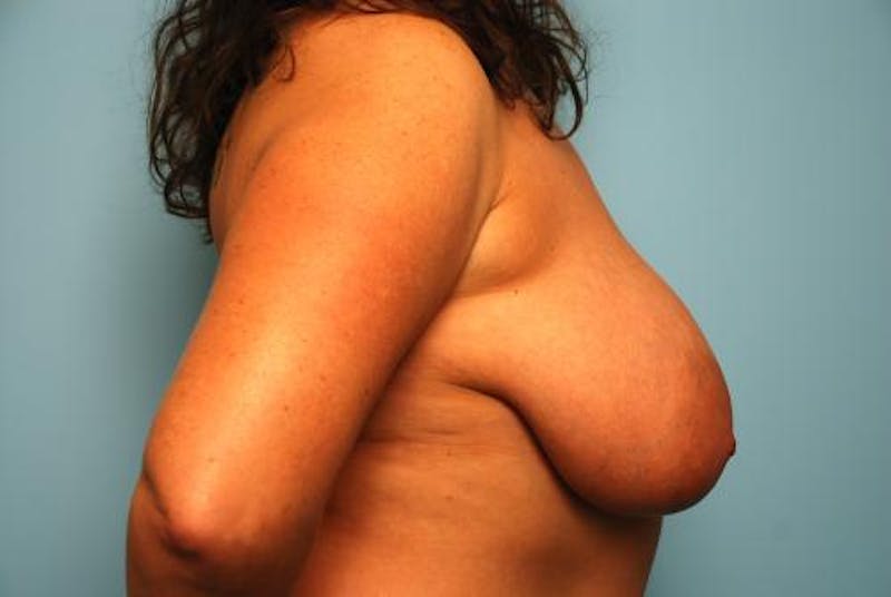 Breast Lift Before & After Gallery - Patient 422335 - Image 5