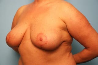 Breast Lift Before & After Gallery - Patient 422335 - Image 8